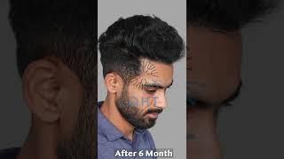 Before / After Result from QHT Clinic #hairtransplant #hairloss #hair #haircare #hairtransformation