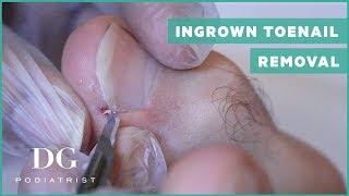 Ingrown Toenail removal treatment (Left foot)