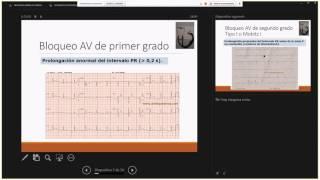 VIDEOCONFERENCIA 21 03 17 BLOQUEOS Y ARRITMIAS SUPRAVENTRICULARES