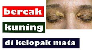 BERCAK KUNING DI KELOPAK MATA || XANTHELASMA