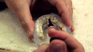 Application of Dentin Flow - JUVORA Dental Disc