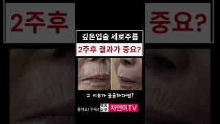 깊은 인중주름 교정, 2주째가 중요한이유?#신촌성형외과 #입술고양이주름영구교정 #은평성형외과 #연세자연미 #입술필러 #홍대성형외과 #은평성형외과