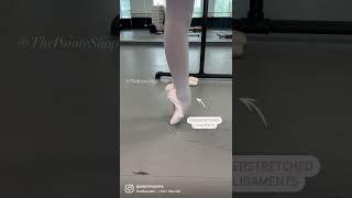 OVERSTRETCHED ligaments en pointe