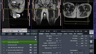 MRI planning Mail pelvis + Testis