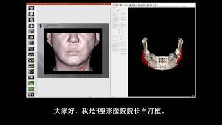 [H整形医院] 人工骨片下颌角重建修复的利弊