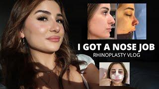 NOSE JOB VLOG (my rhinoplasty experience+ results!) Dr. Vladimir Grigoryants