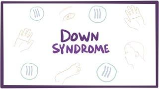 Down syndrome (Trisomy 21) - causes, symptoms, diagnosis, & pathology