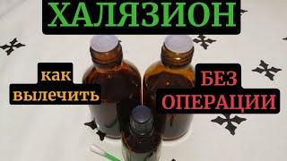 Как вылечить халязион без операции. СМОТРИТЕ ДО КОНЦА! ВСЕ СОВЕТЫ ВАЖНЫ. Лазерное удаление.