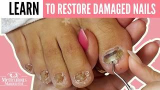 Runner’s Toenail Recovery: Cracked, Raised, and White Spots Toenail Restoration
