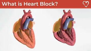 What is Heart Block?