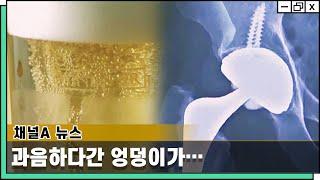 과음하다간 엉덩이가! [채널A 뉴스 방송 - 웰튼병원 송상호 병원장]