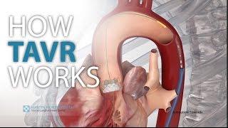 How TAVR works