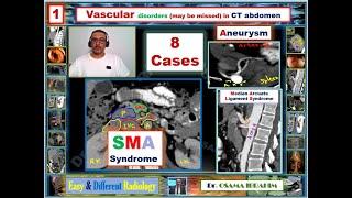 Radiology in GIT : 1- Vascular disorders (may be missed) in CT abdomen