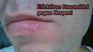 Herpes schnell & zuverlässig wegbekommen - Schwarzer Tee hilft gegen Herpes – Effektives Hausmittel