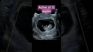 Ultrasound scan showing adorable baby at 11 weeks #ultrasound