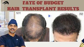 Hair Transplant In Bangalore | Best Results Clinic & Cost Of Hair Transplant In Bangalore