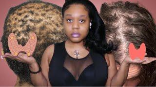 Thyroid CAUSES BALDING! HAIR PRODUCTS WONT HELP BUT THIS VIDEO WILL!! ​⁠@IamCynDoll