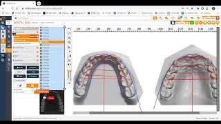 How to make the Tx model (working model) appear in the top box in SS Dental Cad