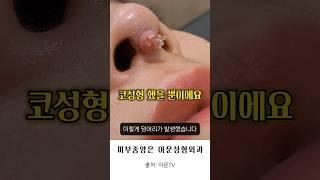 병원 가세요! (코성형 부작용 이물육아종 코기둥 비주 낭종 병원 성형외과 rhinoplasty nose foreign body granuloma seoul korea)[아문TV]