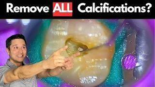 Do You REALLY Need to Remove All Calcifications During a Root Canal?