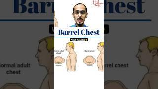 What is Barrel Chest Deformity? #shorts #barrelchest #chestdeformity