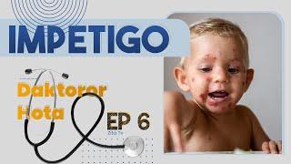 Impetigo Warning: Contagious Skin Infection You Need to Know About | Daktoror Hota Program | Ep6