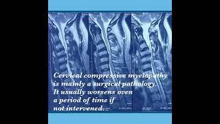 Cervical Myelopathy | Dr. Abhinav Srivastava | गर्दन में नसों का दबना  #cervicalmyelopathy #spinal