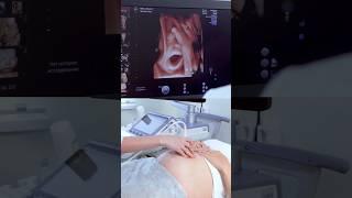 cute baby on ultrasound # #baby #babyultrasound #pregnant #ultrasoundpics