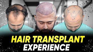 Hair Transplant in India | Best Results & Cost of Hair Transplant in India