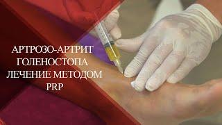 Как лечить деформирующий АРТРОЗ-АРТРИТ ГОЛЕНОСТОПА |PRP лечение после травм в PAN CLINIC