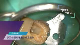 牙齒冒出膿，影片為顯微根管治療中的影像！