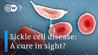 Sickle cell disease: What it is and how to fight it | DW News