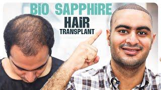 Case Study: Bio-Sapphire Hair Transplant Surgery  | Mumbai | New Roots