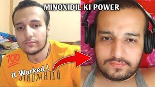 Minoxidil 3 Months Results Beard Growth Journey – Before & After 