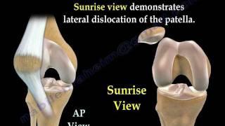 Patellar Dislocations - Everything You Need To Know - Dr. Nabil Ebraheim