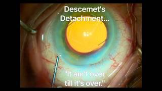 Descemet's detachment during cataract surgery.  "It ain't over till it's over." Shannon Wong, MD