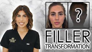 Treatment Breakdown: Filler Transformation with Facial Balancing