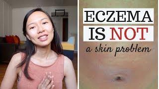 what causes eczema