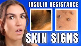 5 Ways Insulin Resistance Changes How You Look!