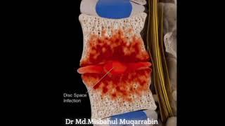Lumbar Discitis