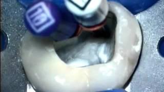 ProUltra Ultrasonics used for canal location | Dentsply Sirona