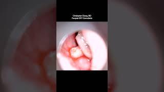 MAGGOTS in the Ear Canal (Myiasis)