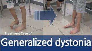 Generalized Dystonia / Cervical Dystonia / Limb dystonia / Torsion dystonia / 전신 사경증 치료사례 / 근긴장이상증