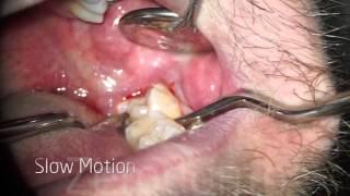 Double Elevator Wisdom Tooth Extraction Without Forceps - Dr. Fabio Cozzolino | Zerodonto