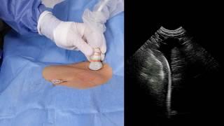 Microconvex Probe Subclavian Central Venous Catheterisation