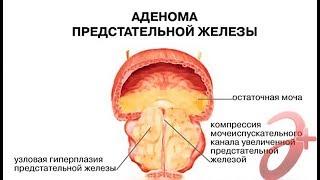 Аденома предстательной железы. Что это такое простыми словами