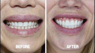 Smile Makeover ( Zirconium Crowns ) - Nicky from Belgium