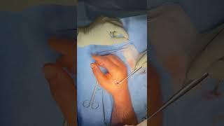 Right Hand Date Palm Thorn Removal 2.0