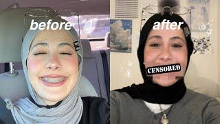 finally getting my braces off at 21 *vlog*