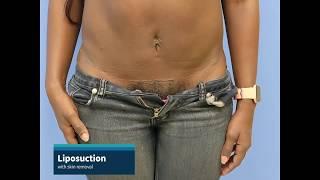 Liposuction with lower tummy skin removal.